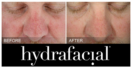 Sun Damage